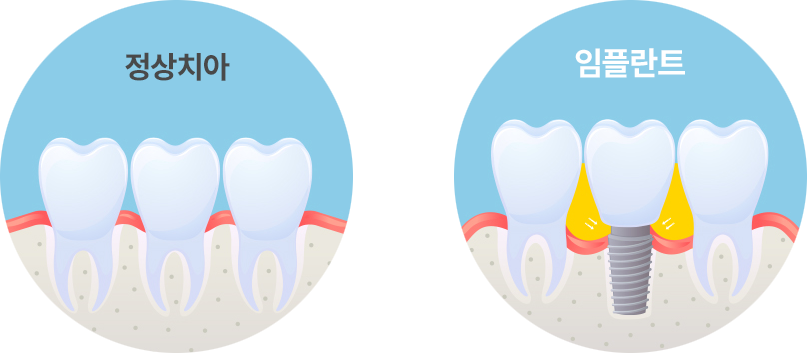 정상치아 VS 임플란트