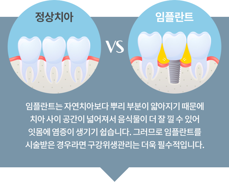 정상치아 VS 임플란트 - 임플란트는 자연치아보다 뿌리 부분이 얇아지기 때문에 치아 사이 공간이 넓어져서 음식물이 더 잘 낄 수 있어 잇몸에 <br>염증이 생기기 쉽습니다. 그러므로 임플란트를 시술받은 경우라면 구강위생관리는 더욱 필수적입니다.